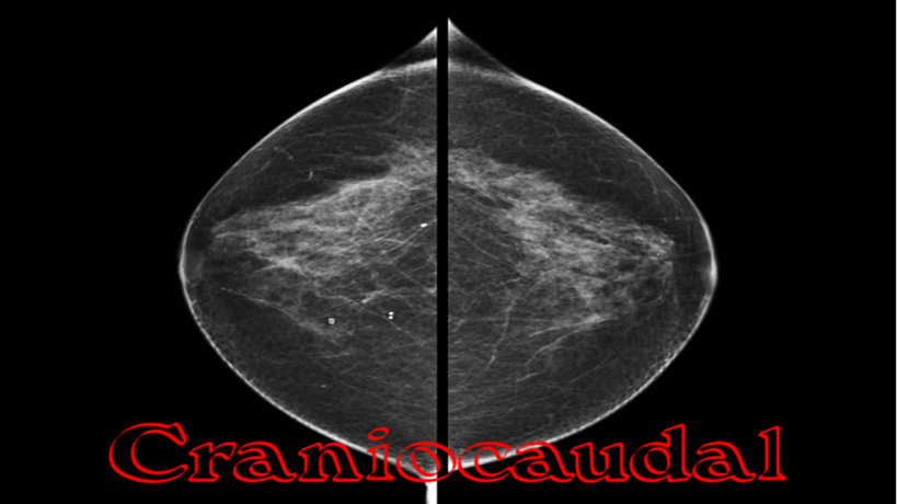 Craniocaudal View Mammogram