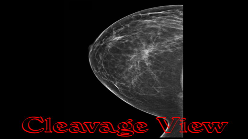 Cleavage view in a mammogram