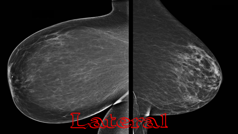Lateral view on mammogram