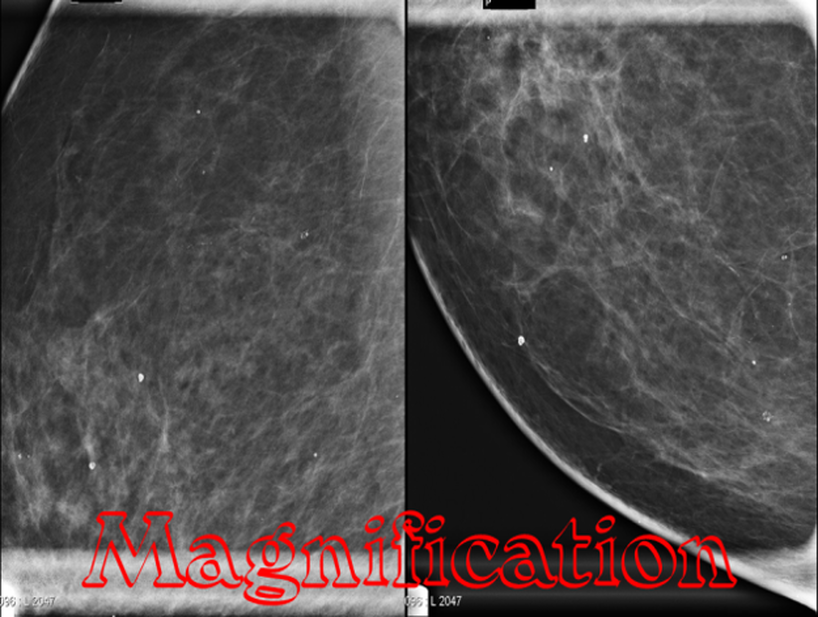 Magnification views in mammogram