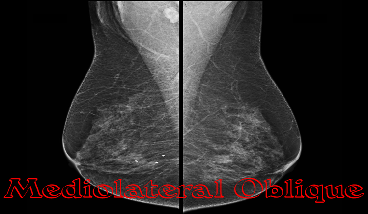 Mediolateral Oblique Mammogram View