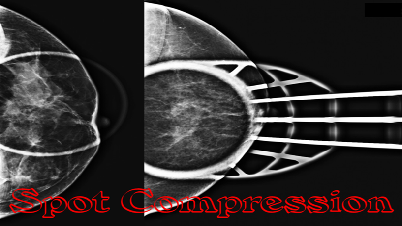 Spot compression view in mammogram