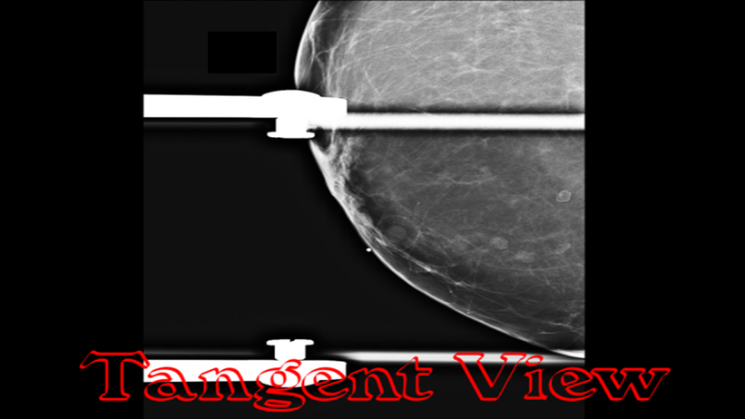 Tangent view in mammogram