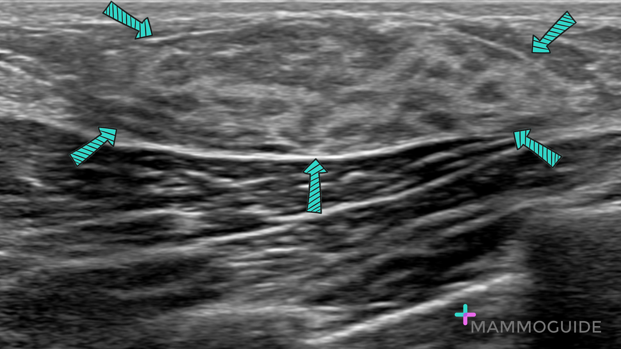 Accessory breast tissue on ultrasound