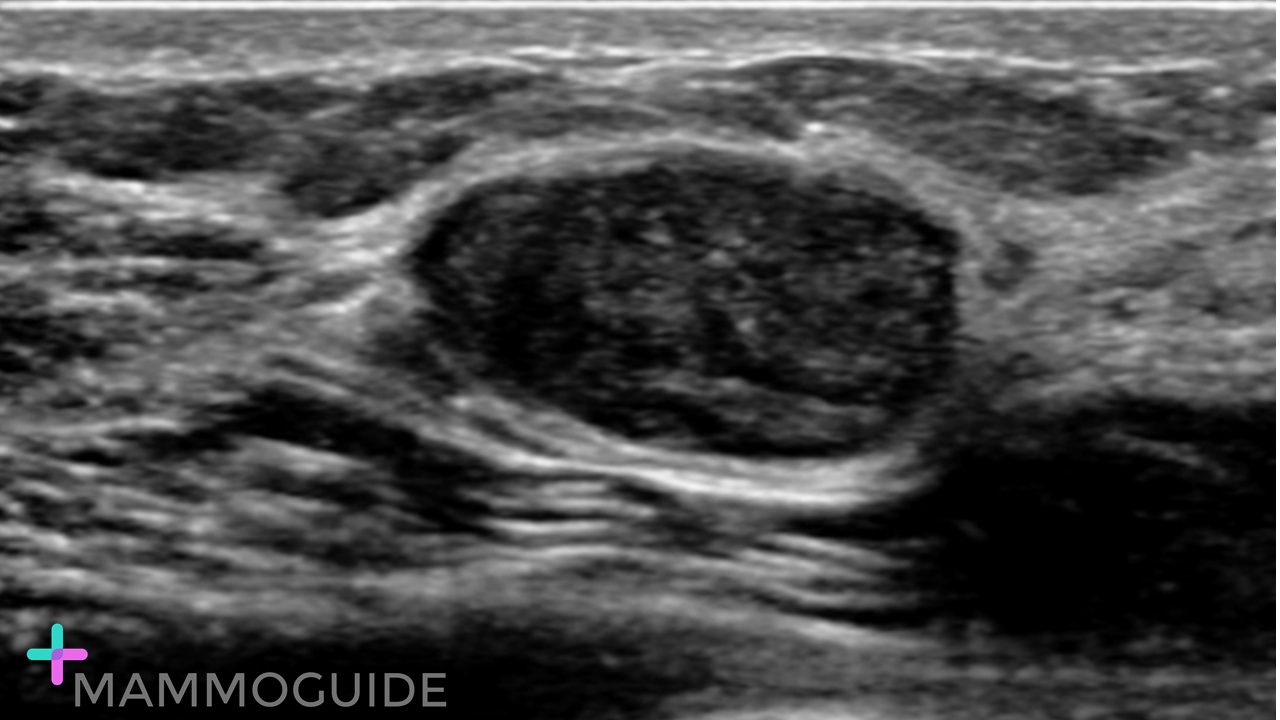 Benign fibroadenoma on ultrasound