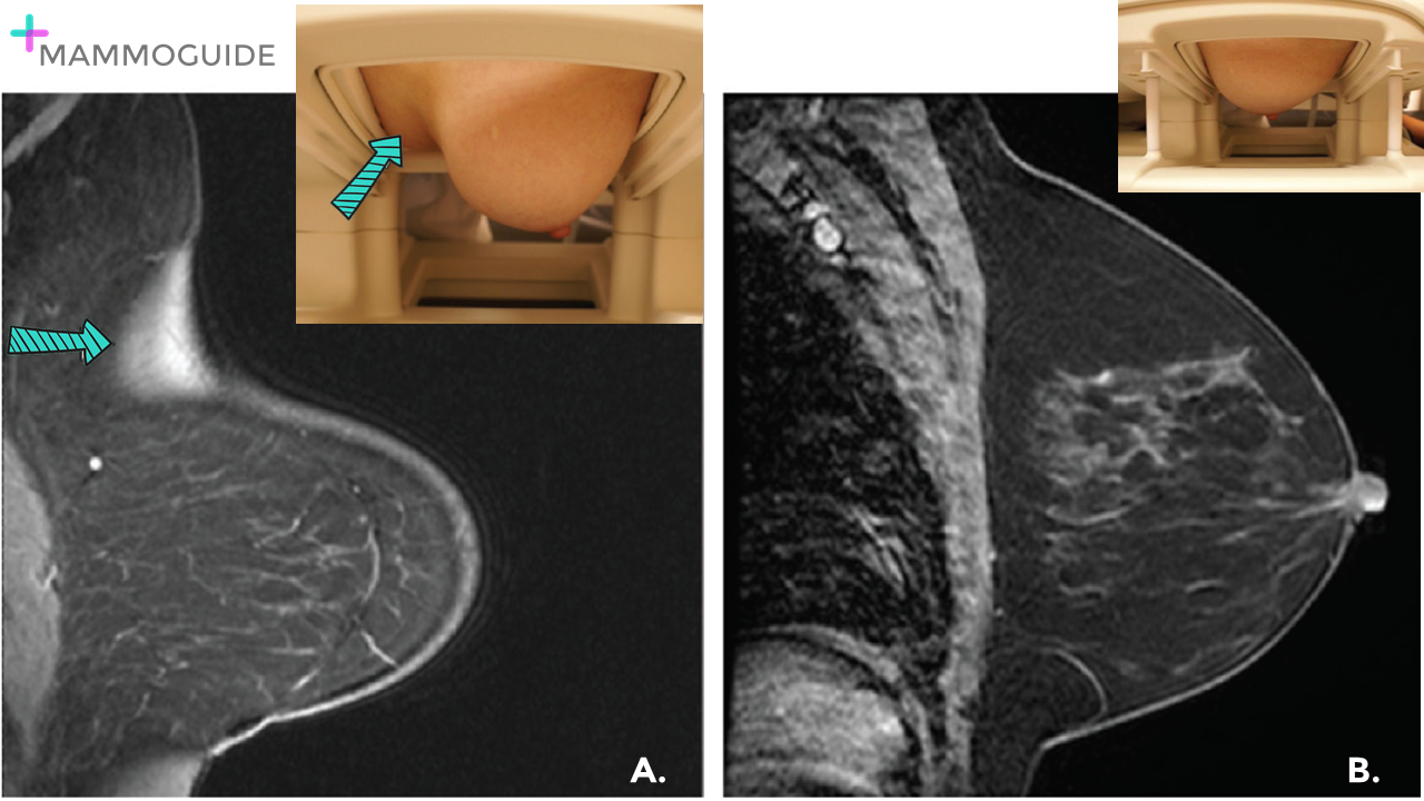 Coil Artifact on Breast MRI