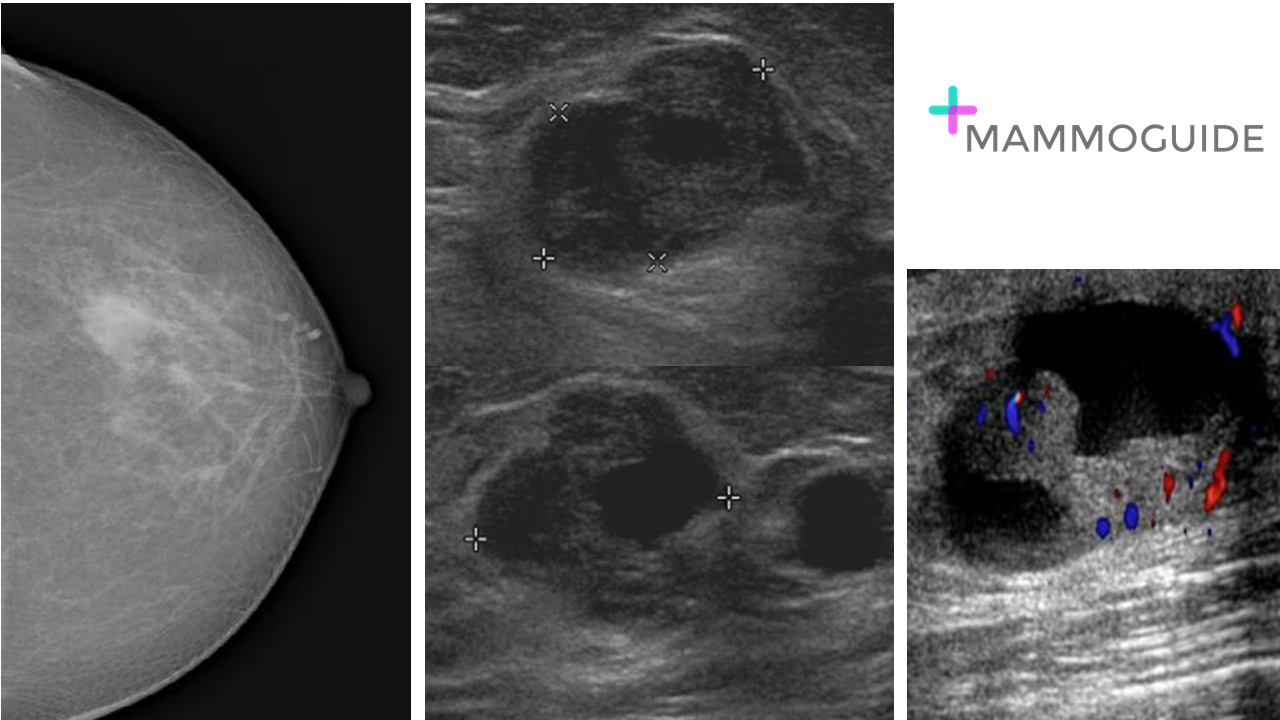 complex cyst on breast ultrasound