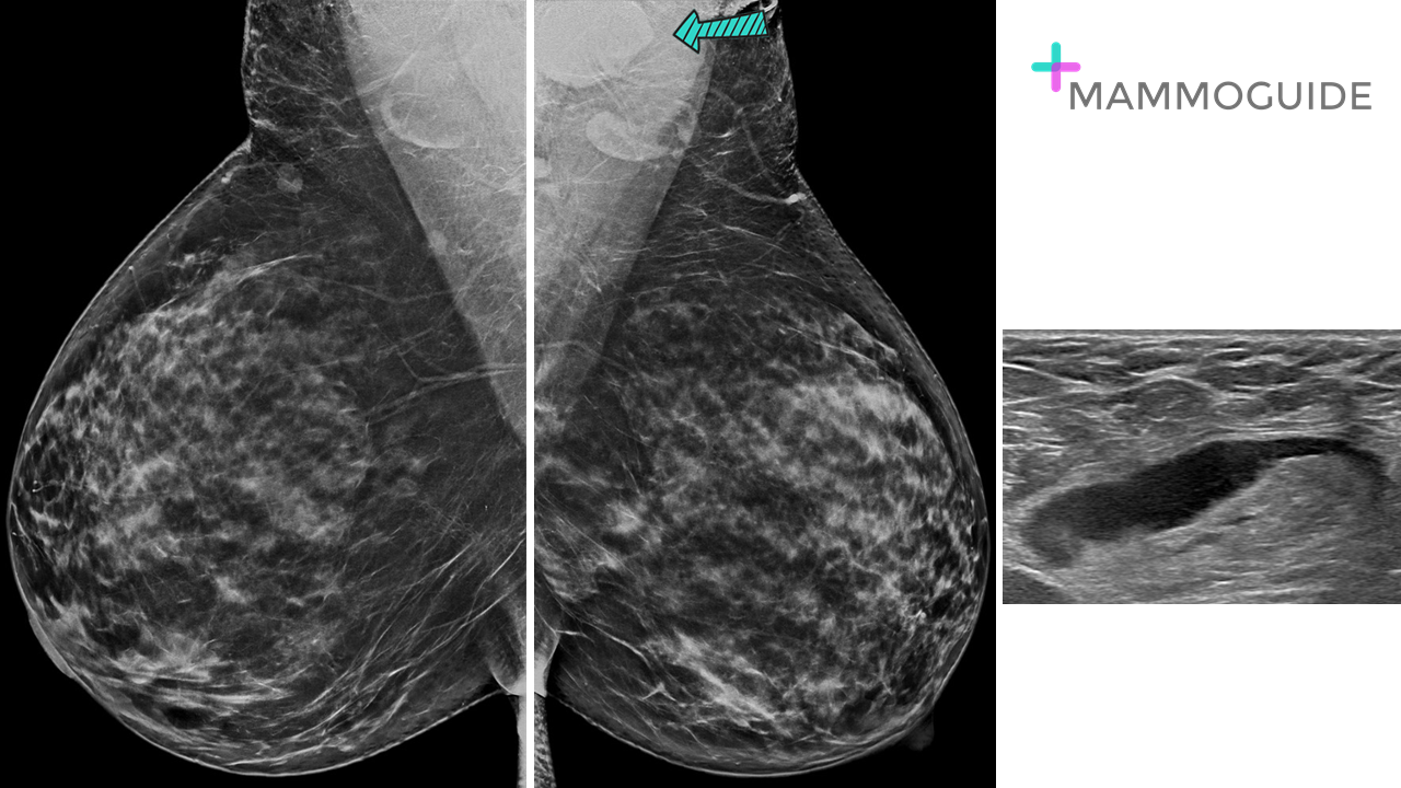 COVID vaccination findings on mammography
