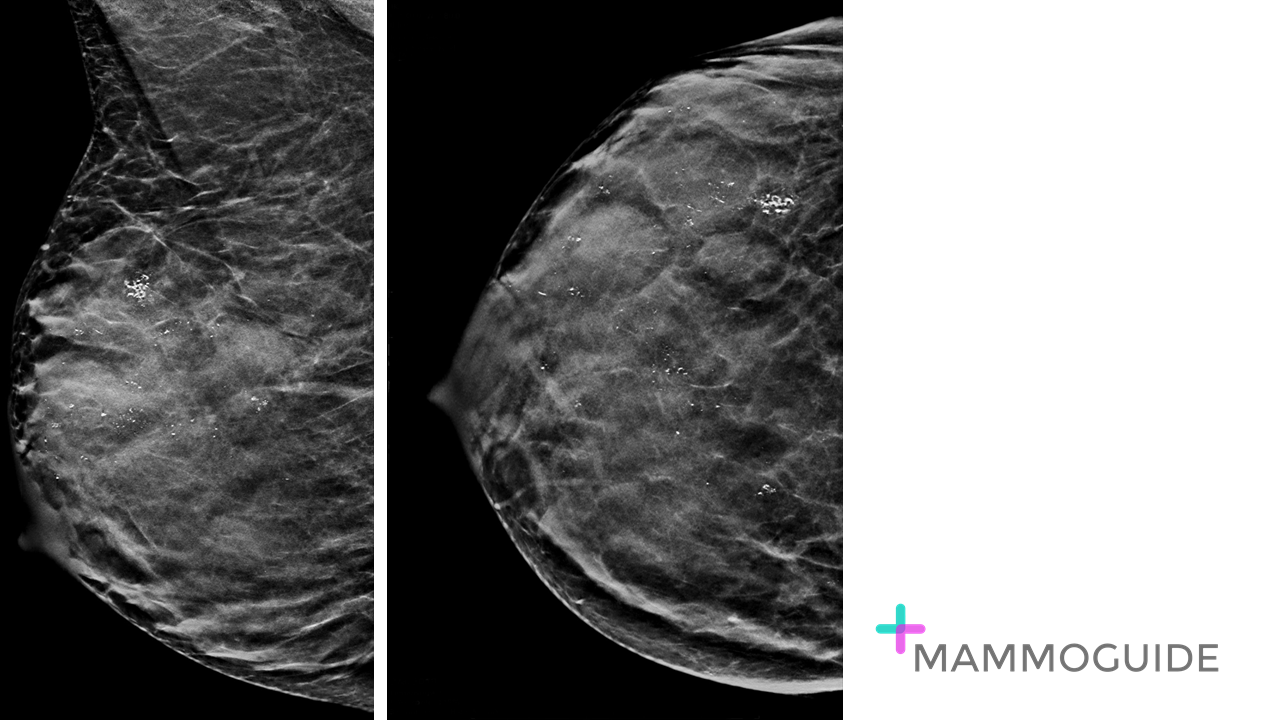 Diffuse calcifications on mammography