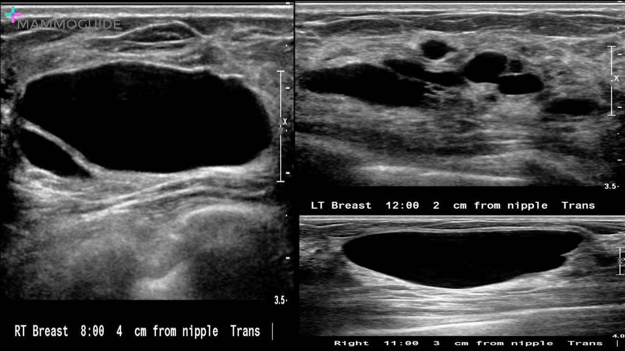 Fibrocystic Changes on Breast Ultrasound