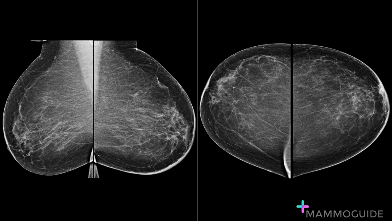 inflammatory breast cancer