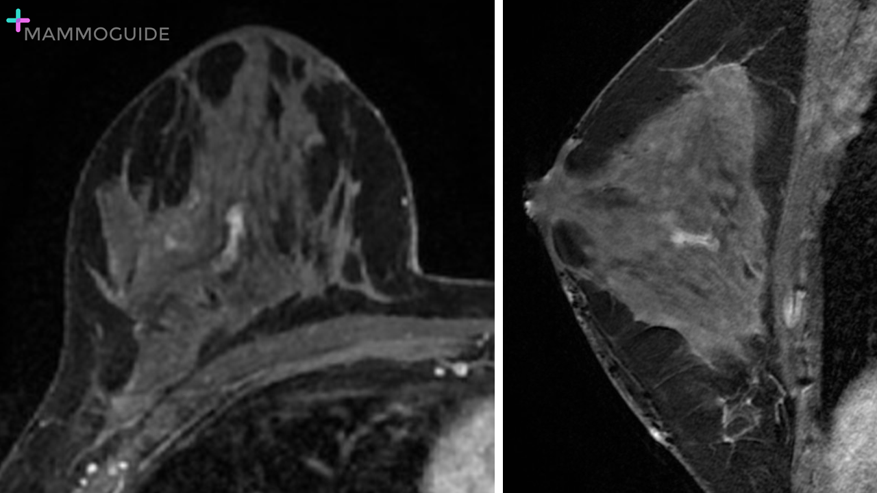 Linear Non-mass Enhancement on Breast MRI