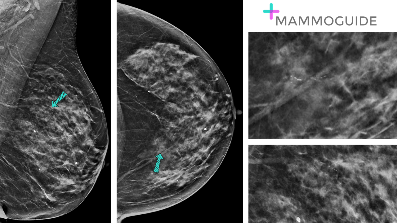 Low grade DCIS on mammography