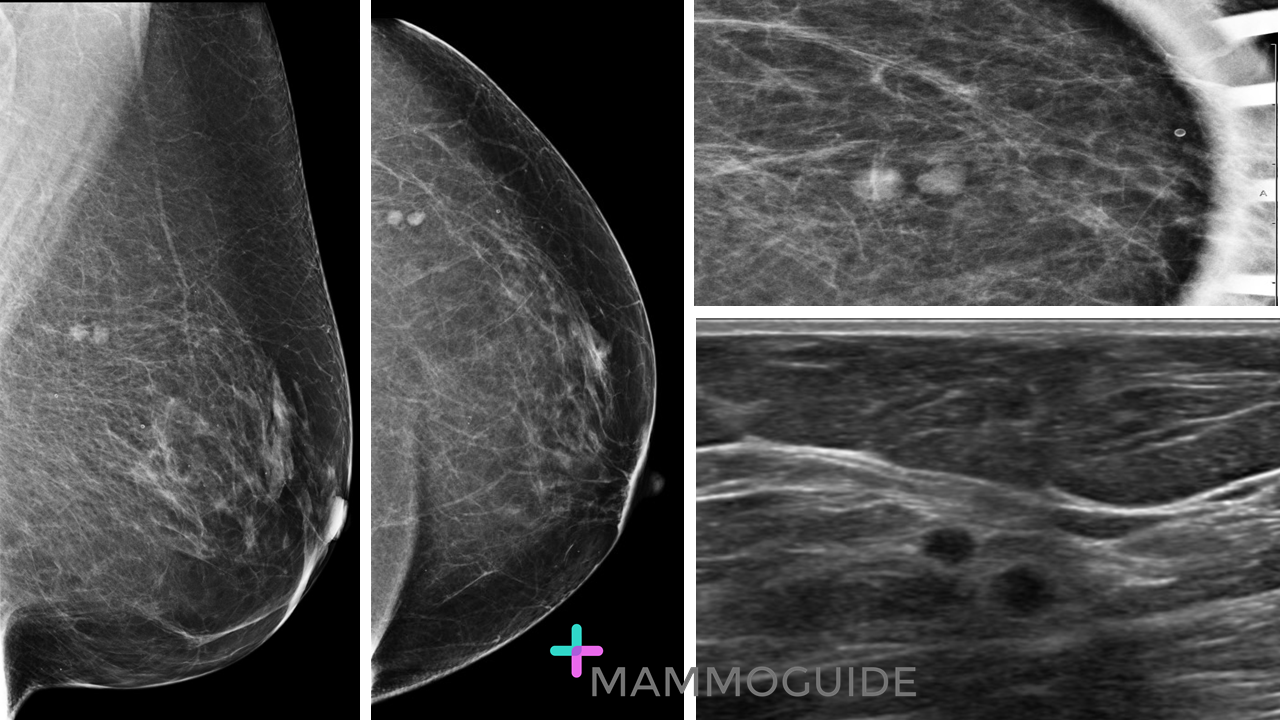 Intramammary Node Mimic on Mammography