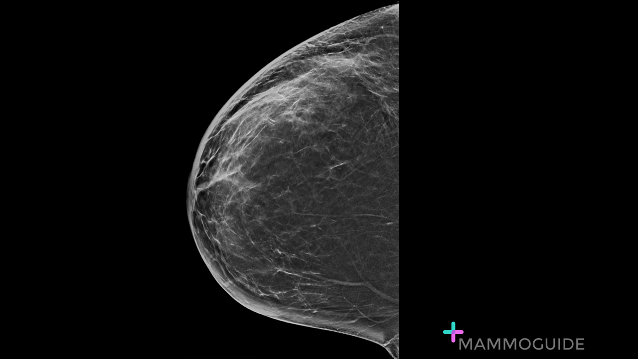 mastitis on breast imaging