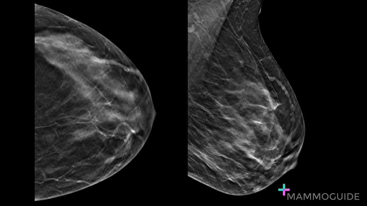 mondor's disease on breast imaging