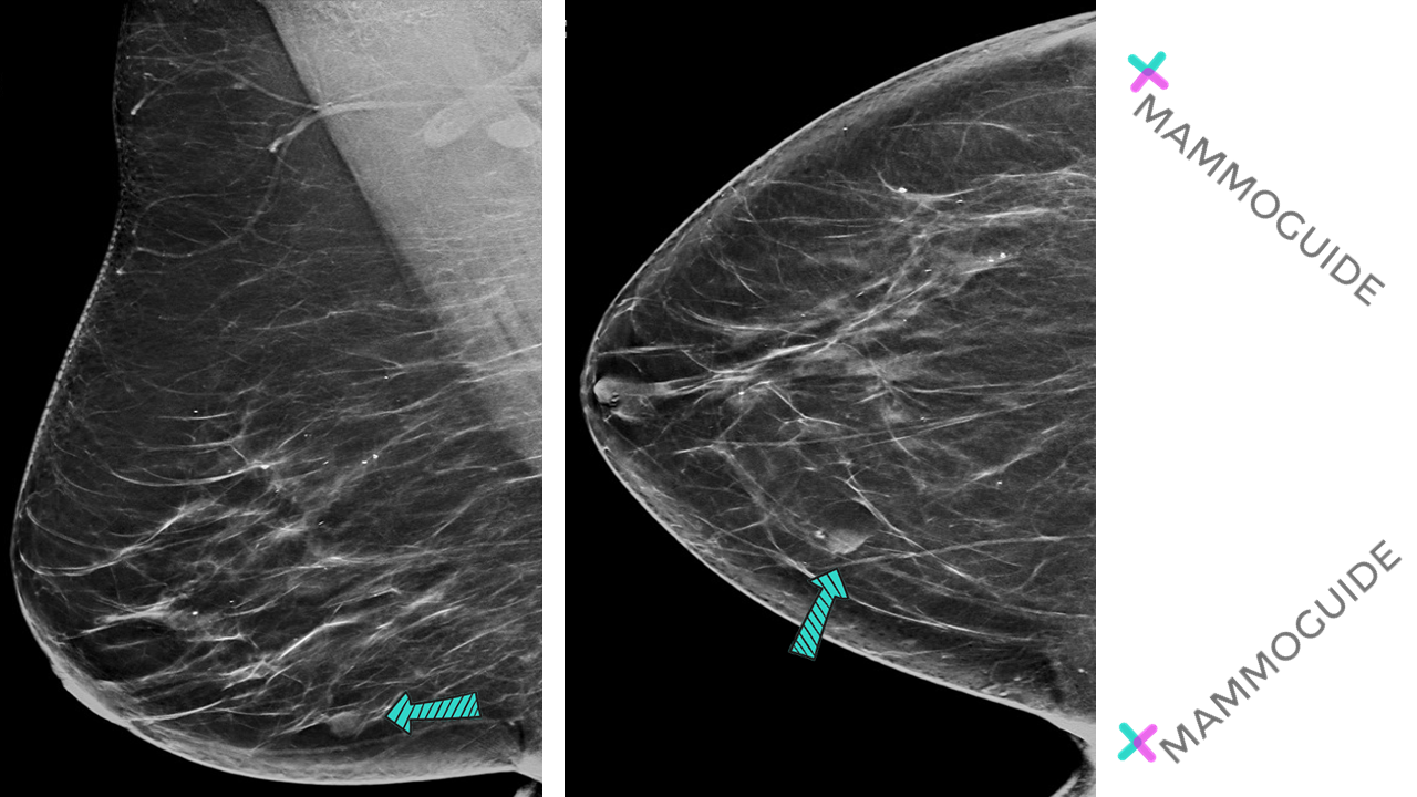 Mucinous Carcinoma on Mammography