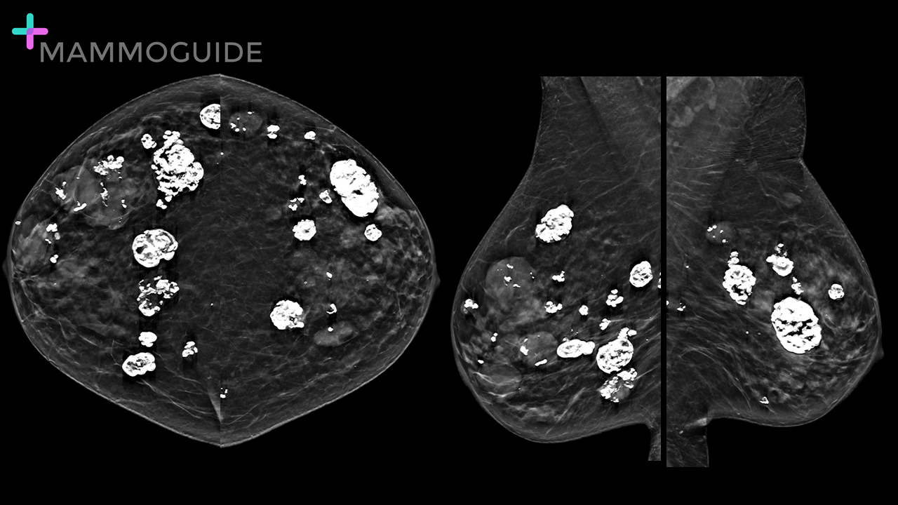 multiple round masses on mammography