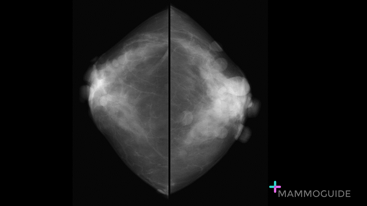 neurofibromatosis on mammography