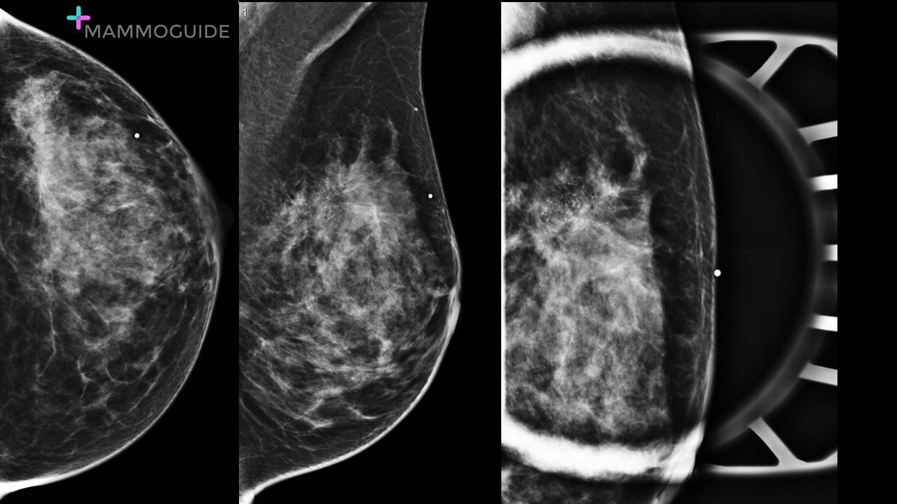 Palpable Mass on Mammography
