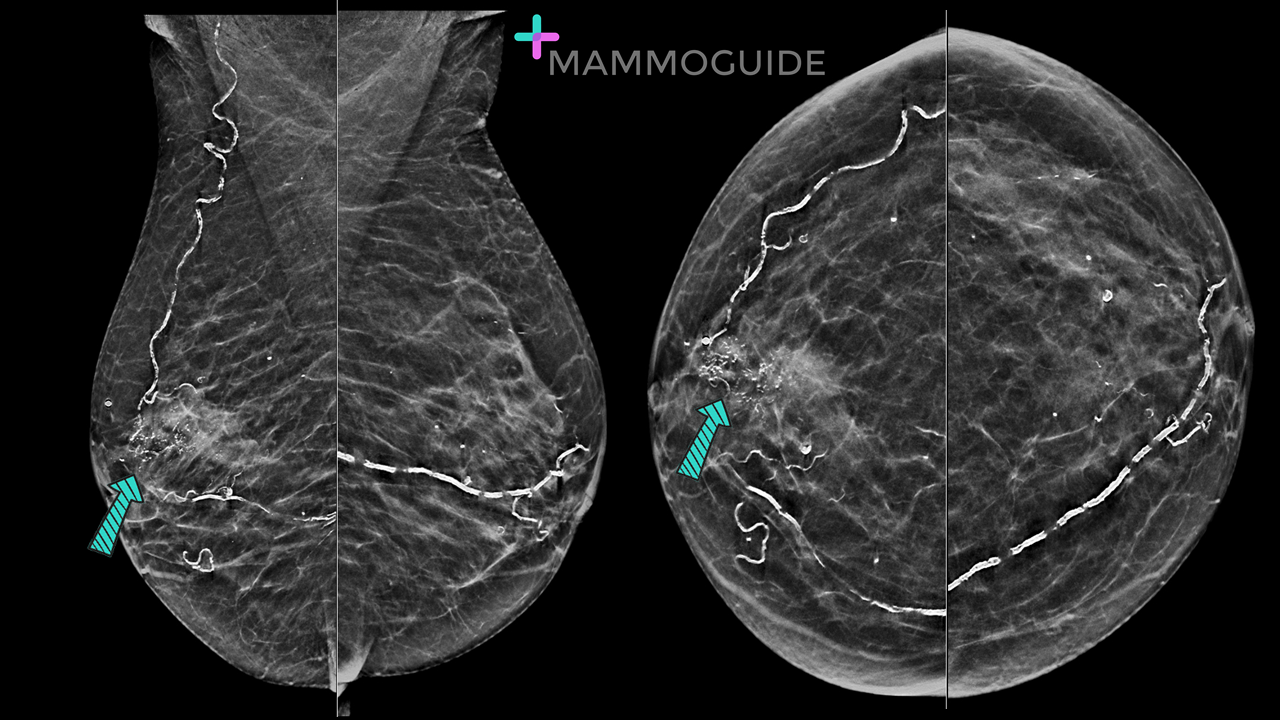 Pleomorphic Calcifications on Mammography