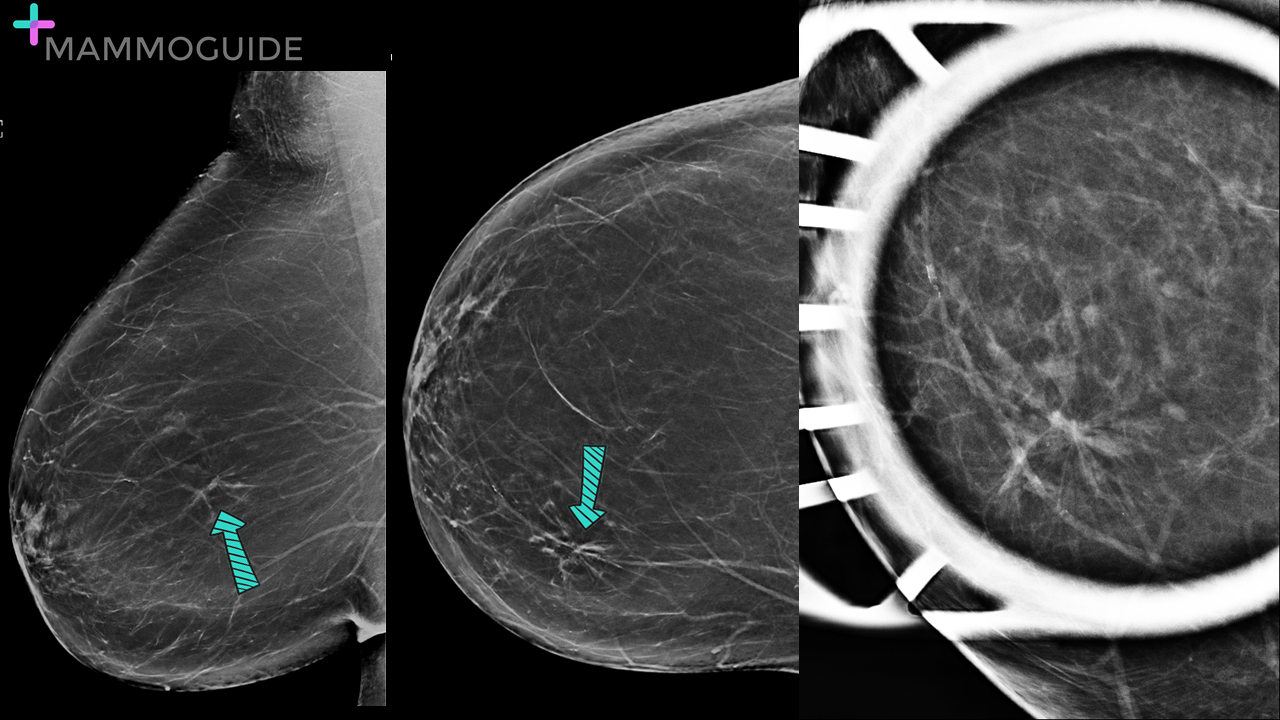 Radial scar on mammography