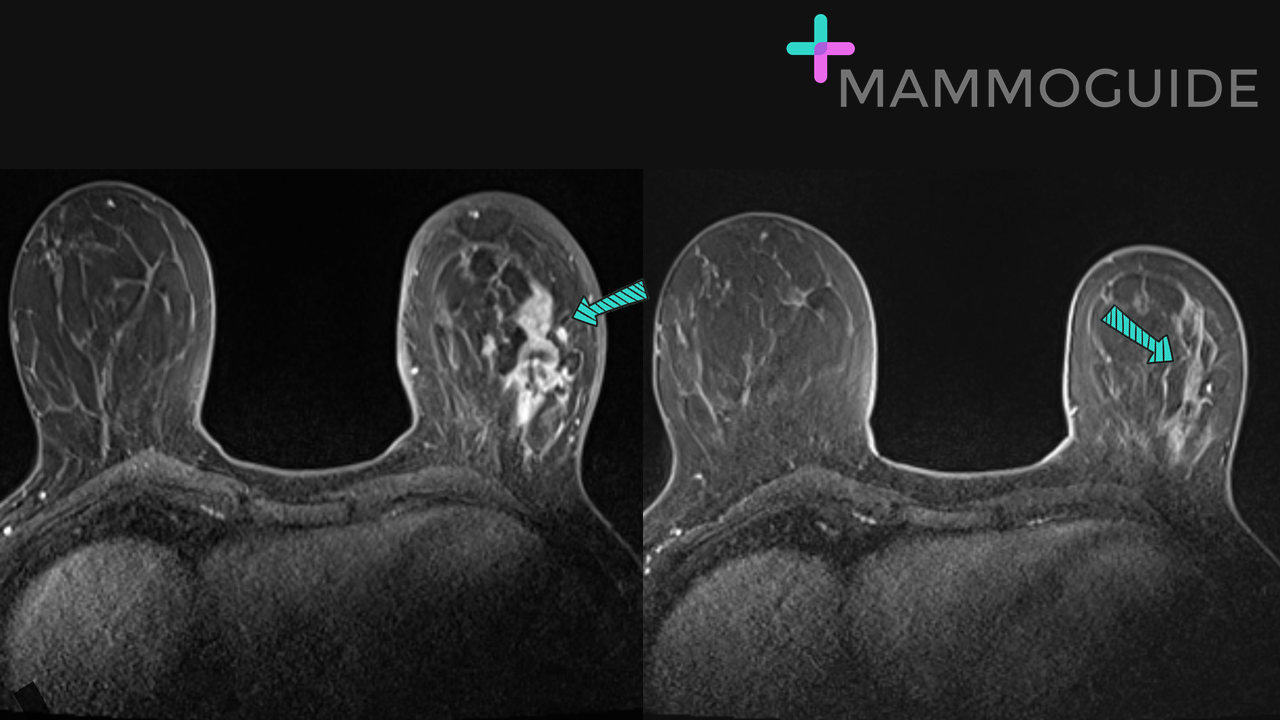 Response to chemotherapy on breast MRI