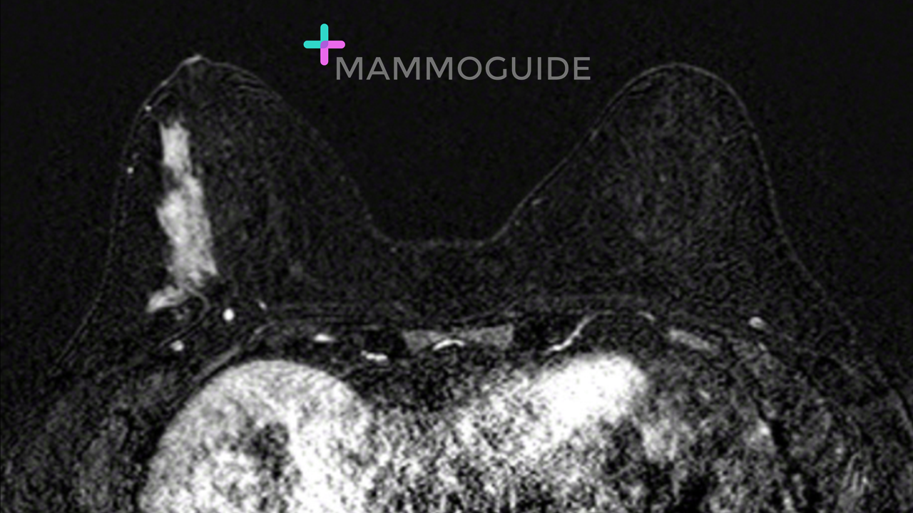Segmental Non-mass Enhancement on Breast MRI