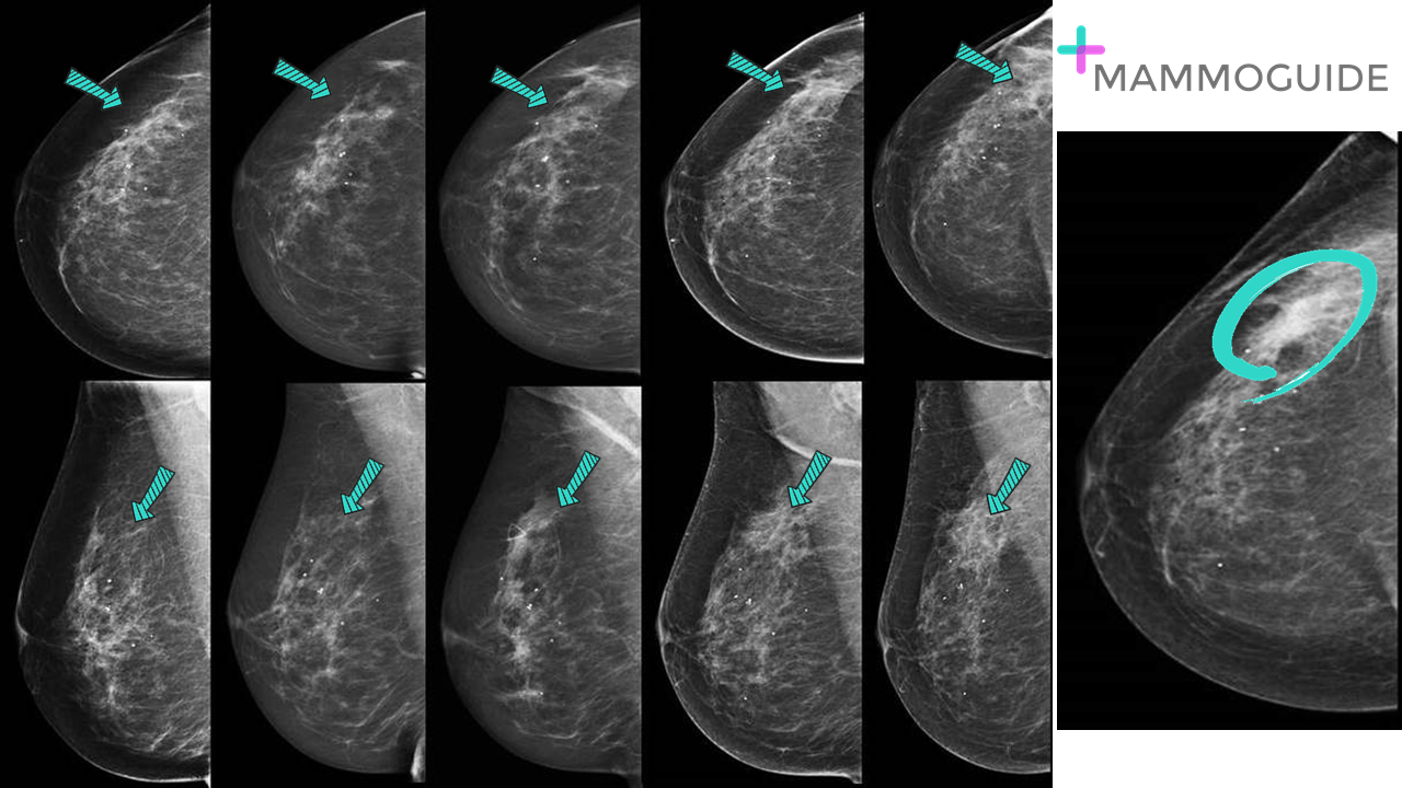 Slow Growing Developing Assymetry of Mammography