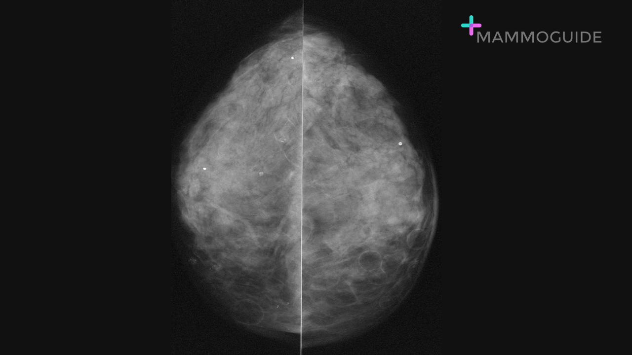 Steatocystoma Multiplex on mammogram