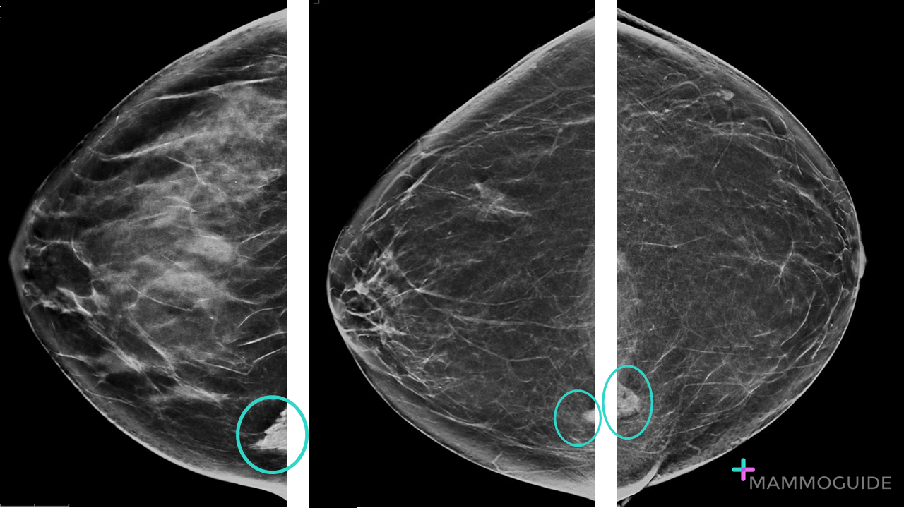 Sternalis muscle on mammography