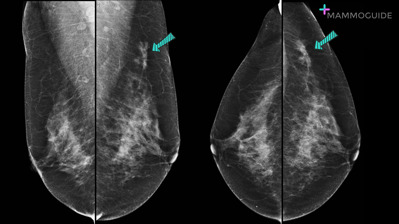 Suspicious Focal Asymmetry on Mammography 