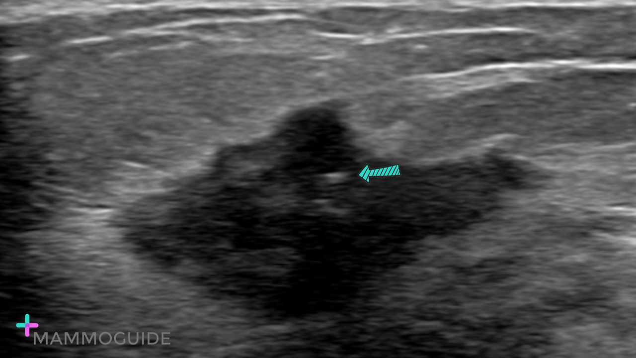 Suspicious breast mass with calcification on ultrasound