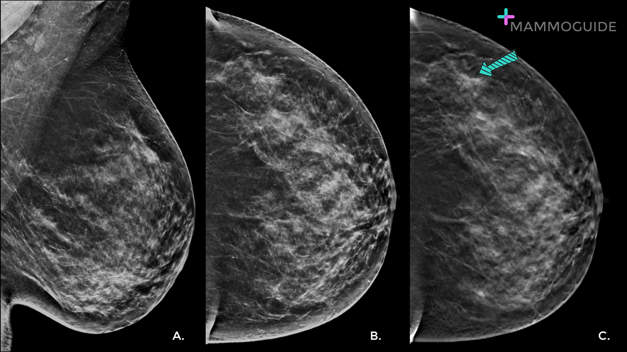 Tomo Predominant Finding on Mammography